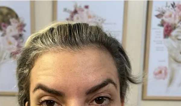 15 dias depois da toxina botulínica: testa mais lisa