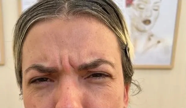 Antes: glabela franzida