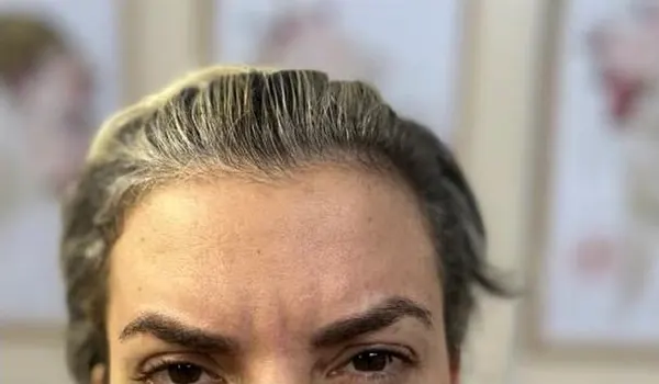 15 dias depois: menos contração entre as sobrancelhas