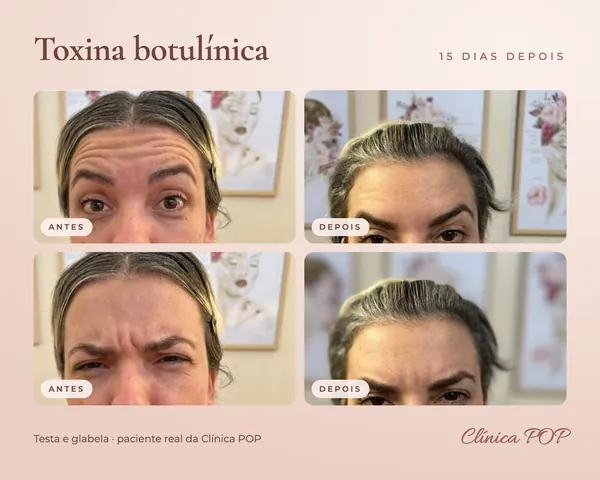 Antes e depois de toxina botulínica na testa e na glabela, 15 dias depois, em paciente da clínica