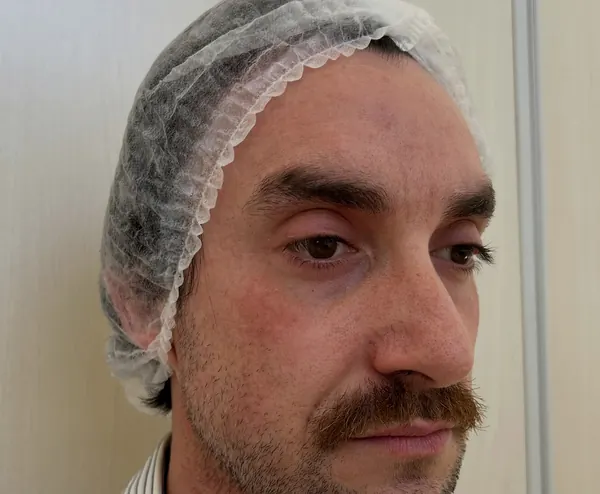 Paciente de harmonização facial masculina na cadeira, de touca, visto de três quartos